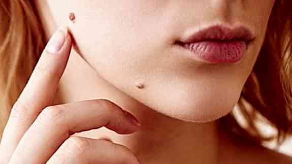 Удаление доброкачественных новообразований в Алматы | Клиника Restetica