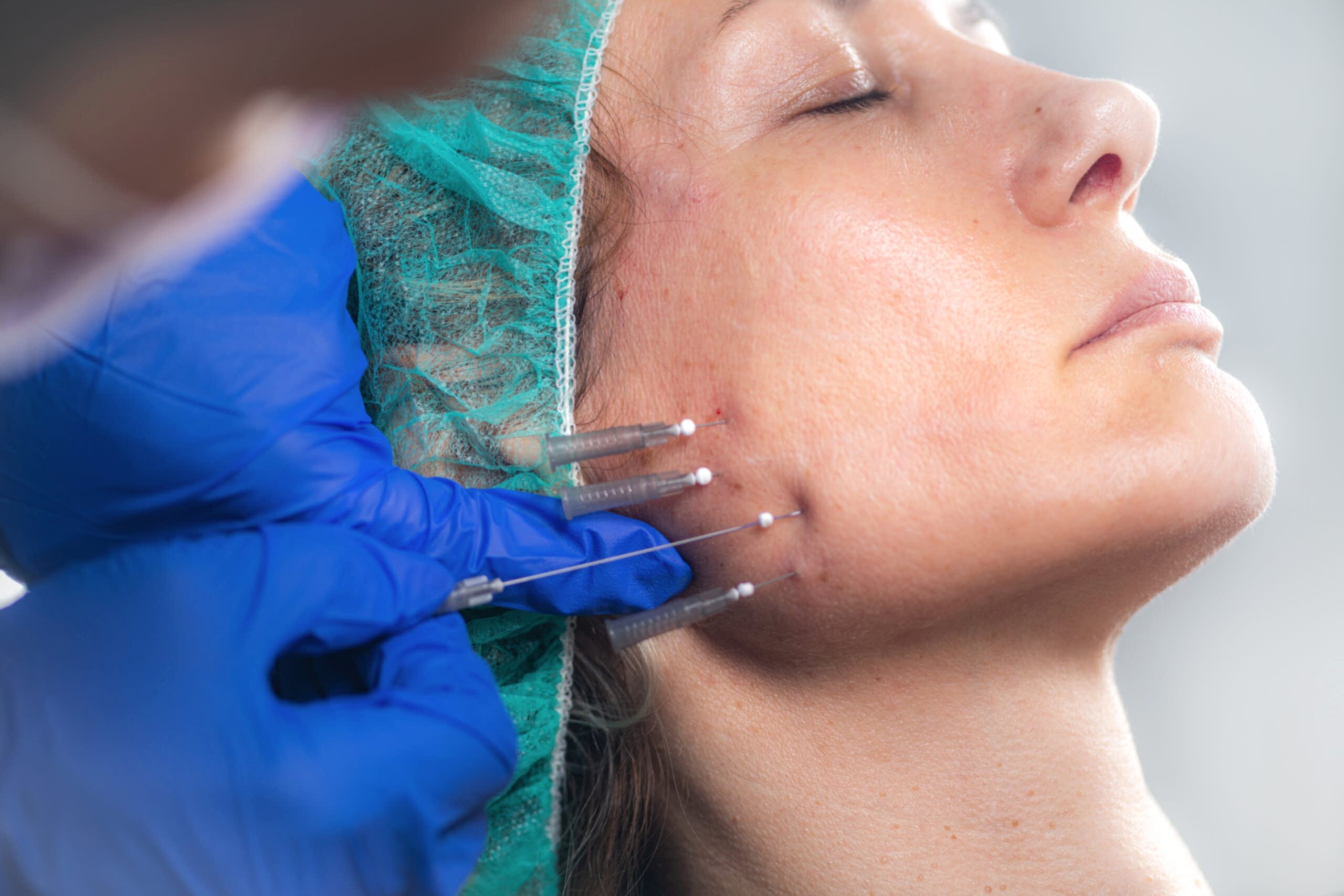 Подтяжка лица нитями в Алматы | Клиника Restetica