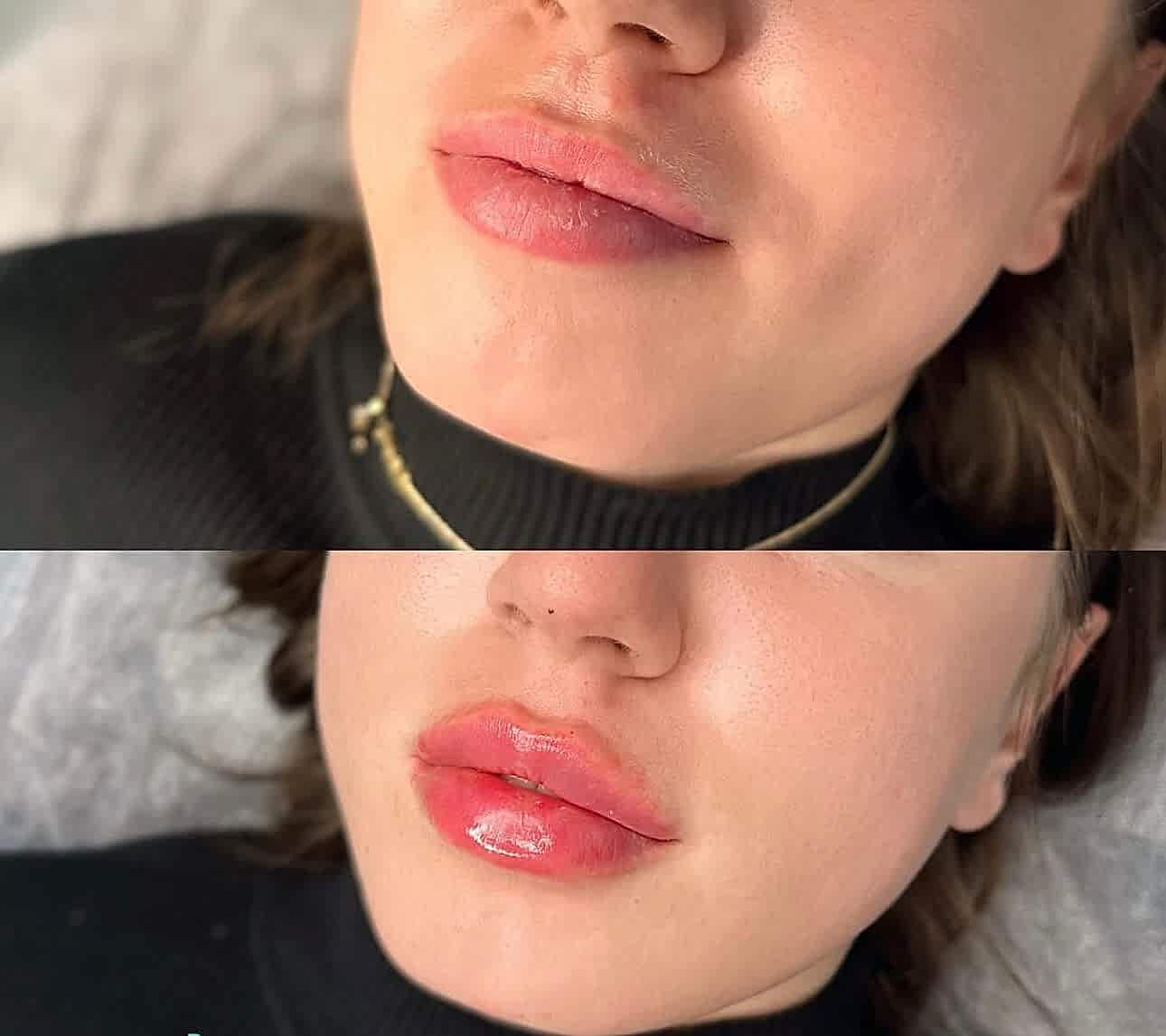 Контурная пластика в Алматы | Клиника Restetica